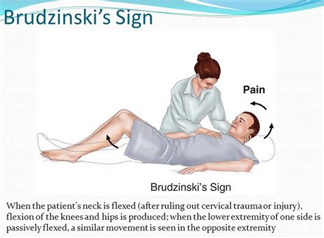 signs for meningitis brudzinski sign
